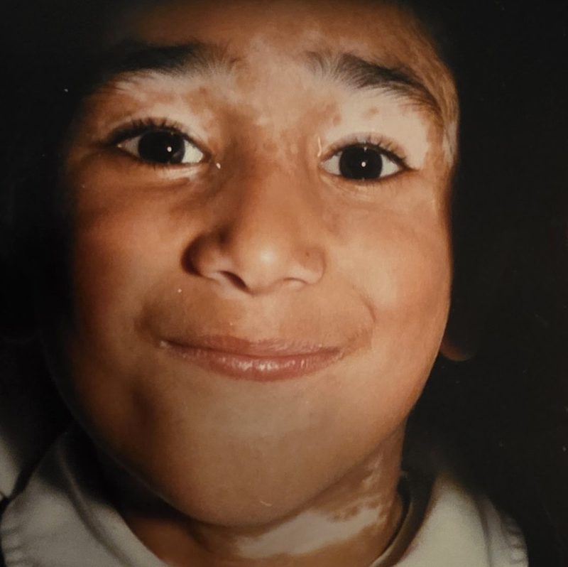 Mitesh aged four, smiling, with white vitiligo patches around his eyes and neck